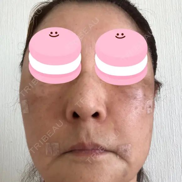 脂肪吸引（顔） / 脂肪注入（額） / 切開リフト 札幌ル・トロワ ビューティクリニックVogue DAY 106 メイン用