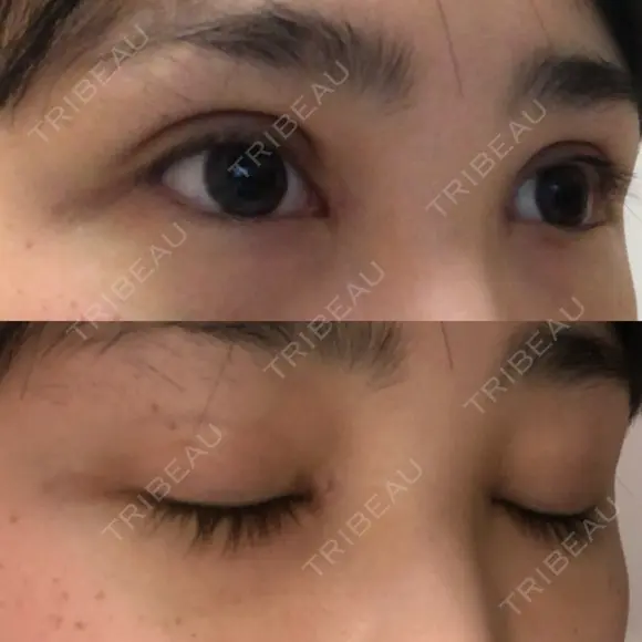 二重埋没 / 目頭切開 / 上まぶたの脂肪取り 湘南美容クリニック 柏院 DAY 12 メイン用