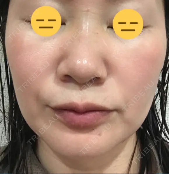 糸リフト / 脂肪吸引（顔） / ボトックス（エラ・小顔） 銀座マイアミ美容外科 DAY 24 メイン用