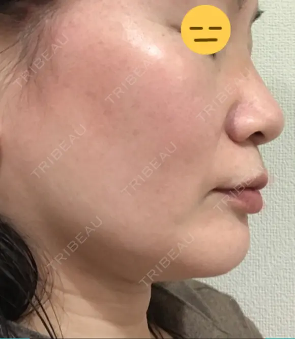 糸リフト / 脂肪吸引（顔） / ボトックス（エラ・小顔） 銀座マイアミ美容外科 DAY 24 メイン用