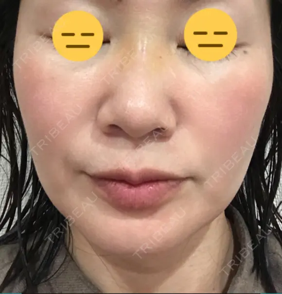 糸リフト / 脂肪吸引（顔） / ボトックス（エラ・小顔） 銀座マイアミ美容外科 DAY 25 メイン用