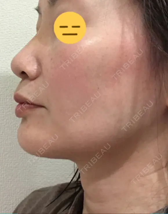 糸リフト / 脂肪吸引（顔） / ボトックス（エラ・小顔） 銀座マイアミ美容外科 DAY 25 メイン用