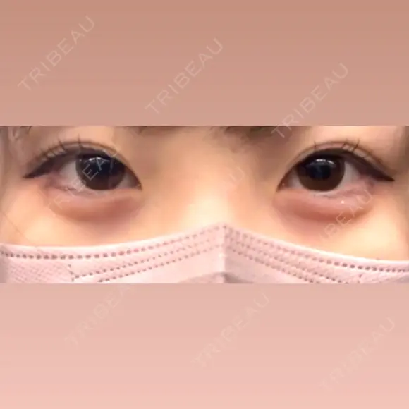ヒアルロン酸注入（涙袋） 渋谷美容外科クリニック 新宿院 DAY 7 メイン用