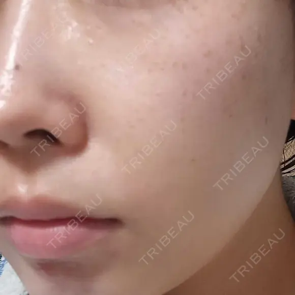 光治療（フォトフェイシャルなど） / ピーリング（ハリ・ツヤ） AURORA CLINIC（オーロラクリニック）新宿院 DAY 0 メイン用