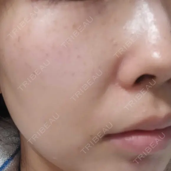 光治療（フォトフェイシャルなど） / ピーリング（ハリ・ツヤ） AURORA CLINIC（オーロラクリニック）新宿院 AFTER メイン用