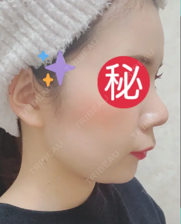 隆鼻術 / 鼻尖形成（切開） / 小鼻縮小（切開） / 軟骨移植 あいちビューティークリニック栄本院 AFTER メイン用