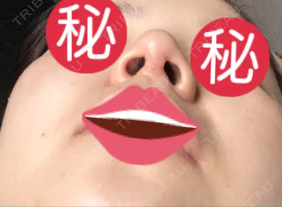 隆鼻術 / 鼻尖形成（切開） / 小鼻縮小（切開） / 軟骨移植 あいちビューティークリニック栄本院 DAY 84 メイン用