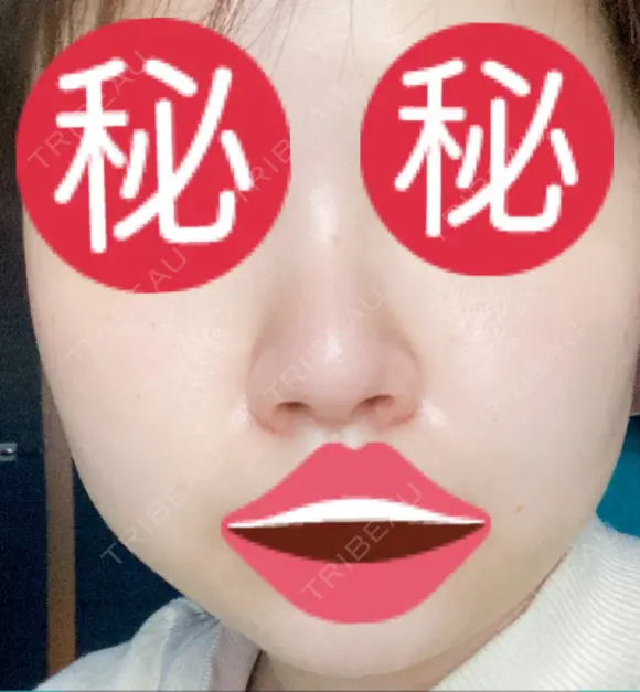 隆鼻術 / 鼻尖形成（切開） / 小鼻縮小（切開） / 軟骨移植 あいちビューティークリニック栄本院 DAY 84 メイン用