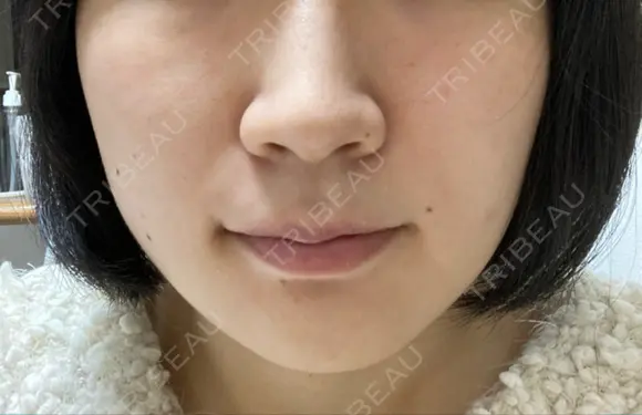 毛穴洗浄（ハイドラフェイシャルなど） 大阪消化器内科・内視鏡クリニック難波院 DAY 0 メイン用
