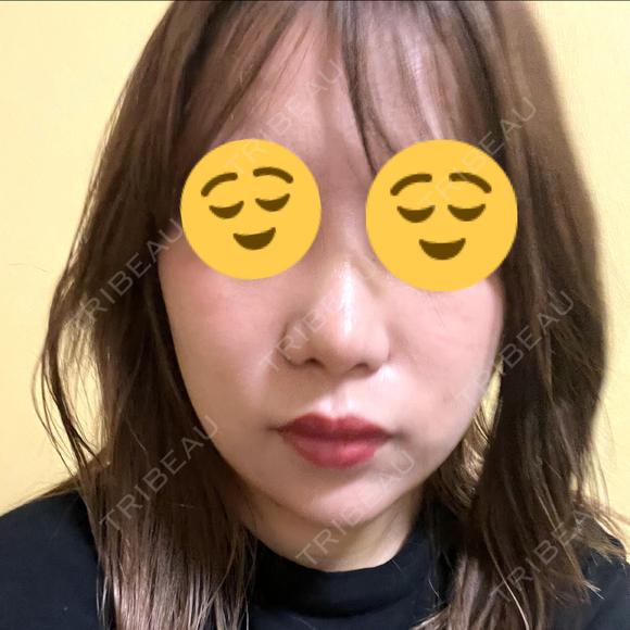 鼻尖形成（切開） / 小鼻縮小（切開） / その他（鼻） YBC横浜美容外科 大宮院 DAY 12 メイン用