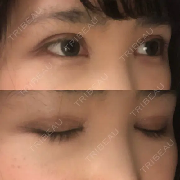 二重埋没 / 目頭切開 / 上まぶたの脂肪取り 湘南美容クリニック 柏院 DAY 13 メイン用