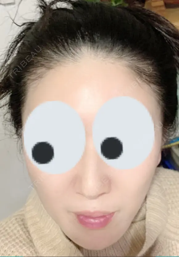 再生医療 クリニックビューティー恵比寿 DAY 38 メイン用