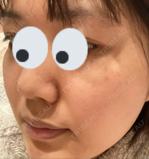 シミ取りレーザー / 光治療（フォトフェイシャルなど） 渋谷美容外科クリニック 新橋院 AFTER メイン用