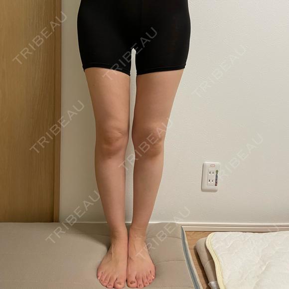 脂肪吸引（脚） オアシス美容外科 DAY 74 メイン用
