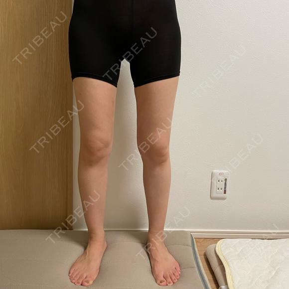 脂肪吸引（脚） オアシス美容外科 DAY 74 メイン用