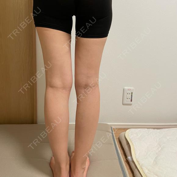 脂肪吸引（脚） オアシス美容外科 DAY 74 メイン用
