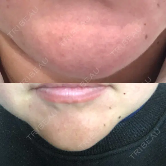 ボトックス（あご） LEAGRANT CLINIC 中目黒 DAY 1 メイン用