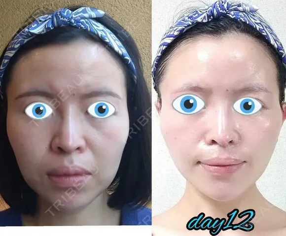 切開リフト LIKI CLINIC KOBE DAY 12 メイン用