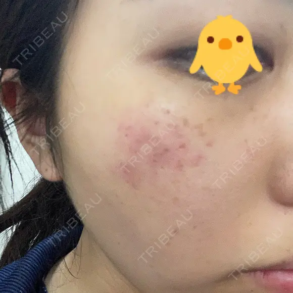 レーザートーニング（美白・肝斑） 渋谷美容外科クリニック 池袋院 DAY 0 メイン用