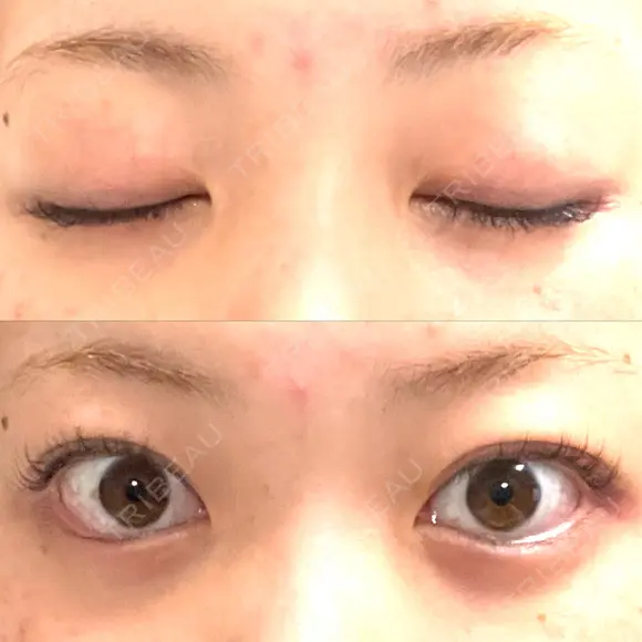 二重埋没 心斎橋中央クリニック AFTER メイン用