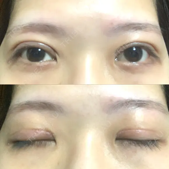 二重切開 / その他（目元） LIKI CLINIC KOBE DAY 35 メイン用