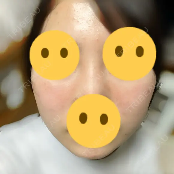 ピーリング（ニキビ・毛穴） 渋谷美容外科クリニック 新宿院 AFTER メイン用