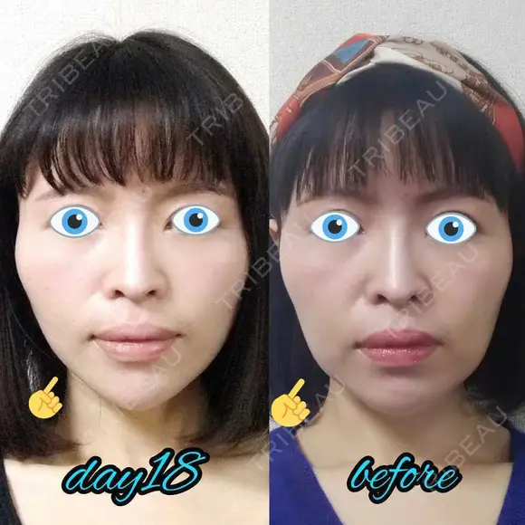 切開リフト LIKI CLINIC KOBE DAY 18 メイン用