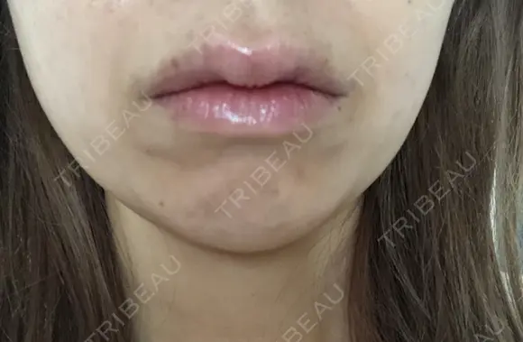 ボトックス（あご） / ボトックス（エラ・小顔） / ヒアルロン酸注入（唇） / ボトックス（口角） / ボトックス（人中） アリエル美容クリニック 大宮院 DAY 0 メイン用