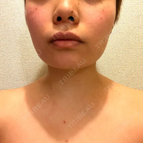 ボトックス（首） KOBE美容皮膚科 西宮院 DAY 10 メイン用