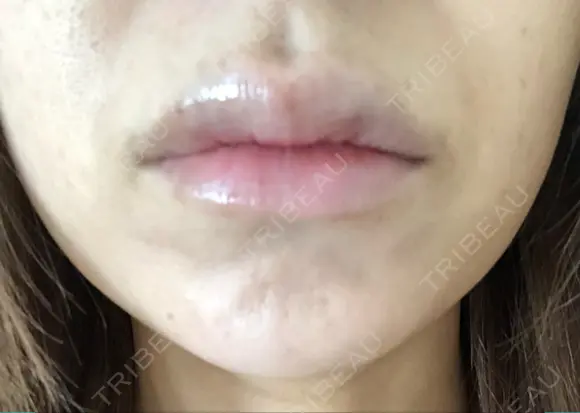 ボトックス（あご） / ボトックス（エラ・小顔） / ヒアルロン酸注入（唇） / ボトックス（口角） / ボトックス（人中） アリエル美容クリニック 大宮院 DAY 1 メイン用