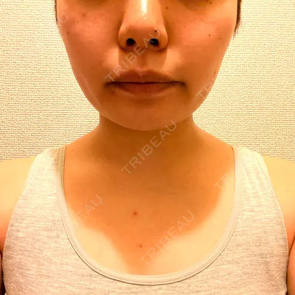 ボトックス（首） KOBE美容皮膚科 西宮院 DAY 9 メイン用