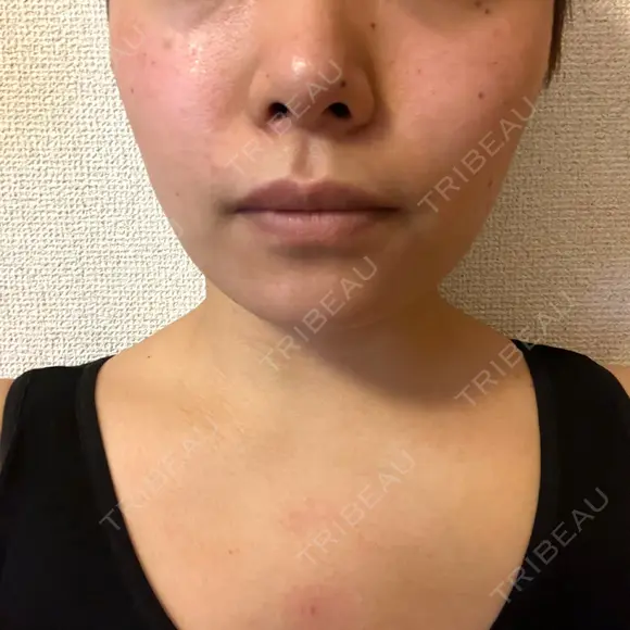 ボトックス（首） KOBE美容皮膚科 西宮院 DAY 8 メイン用