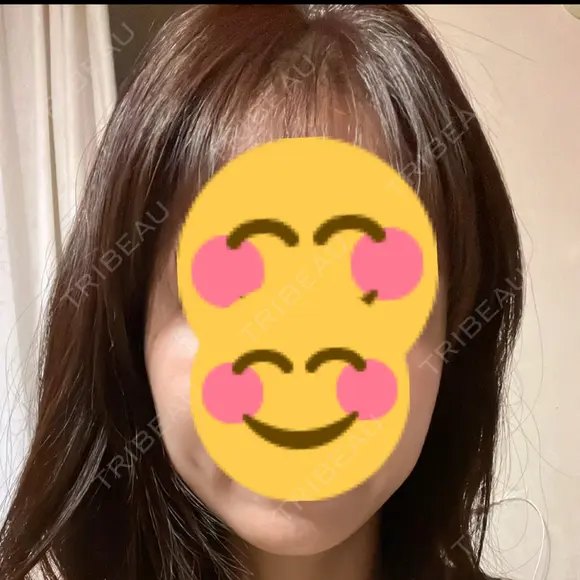 骨削り（エラ） / 骨削り（頬） / 脂肪吸引（顔） View美容整形外科 AFTER メイン用