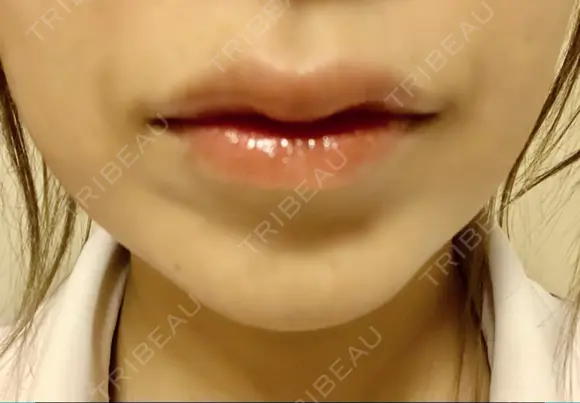 ボトックス（あご） / ボトックス（エラ・小顔） / ヒアルロン酸注入（唇） / ボトックス（口角） / ボトックス（人中） アリエル美容クリニック 大宮院 DAY 2 メイン用