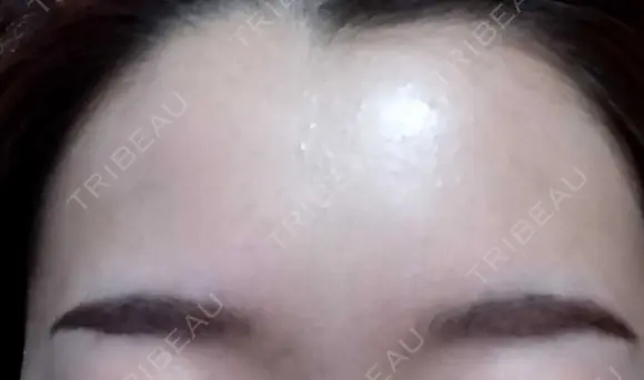 ピーリング（ニキビ・毛穴） / エレクトロポレーション / 光治療（フォトフェイシャルなど） AURORA CLINIC（オーロラクリニック）新宿院 DAY 0 メイン用