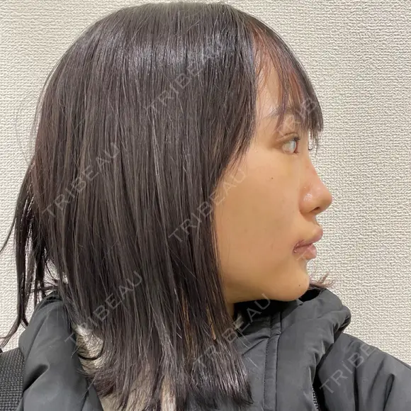 目頭切開 / タレ目形成・グラマラスライン（切開） / 口角挙上 / ボトックス（あご） / その他（口元） 東京形成美容外科 船橋院 DAY 5 メイン用