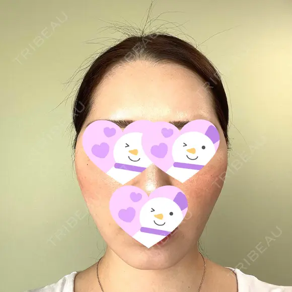 脂肪吸引（顔） / 切開リフト / PRP皮膚再生療法 湘南美容クリニック 新宿本院 DAY 49 メイン用