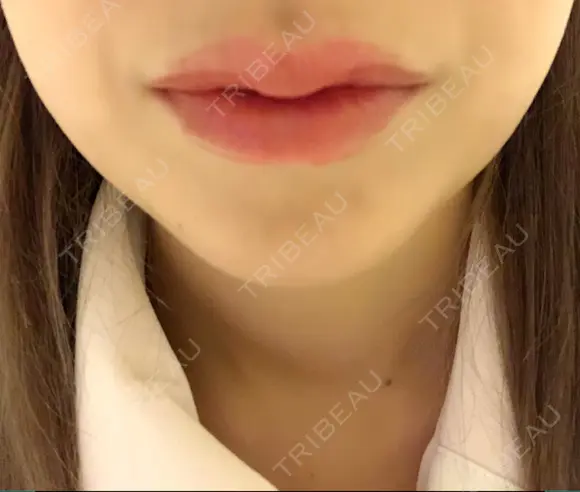 ボトックス（あご） / ボトックス（エラ・小顔） / ヒアルロン酸注入（唇） / ボトックス（口角） / ボトックス（人中） アリエル美容クリニック 大宮院 AFTER メイン用