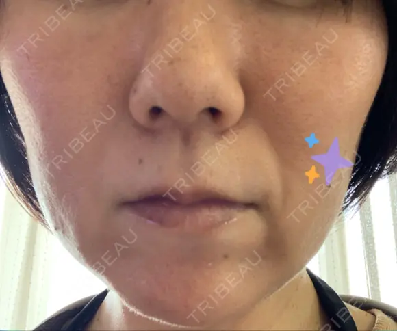 ハイフ（顔） 湘南美容クリニック 大阪京橋院 DAY 7 メイン用