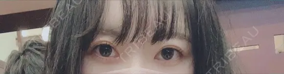 クマ治療 / 下まぶたの脂肪取り 湘南美容クリニック 赤羽院 AFTER メイン用