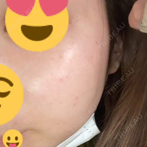 光治療（フォトフェイシャルなど） / ピーリング（ハリ・ツヤ） AURORA CLINIC（オーロラクリニック）新宿院 AFTER メイン用