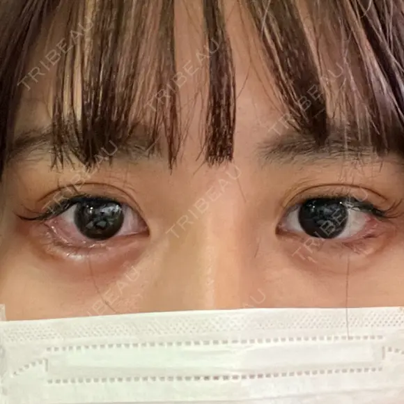 目尻切開 / タレ目形成・グラマラスライン（切開） A CLINIC（エークリニック） 銀座院 DAY 2 メイン用