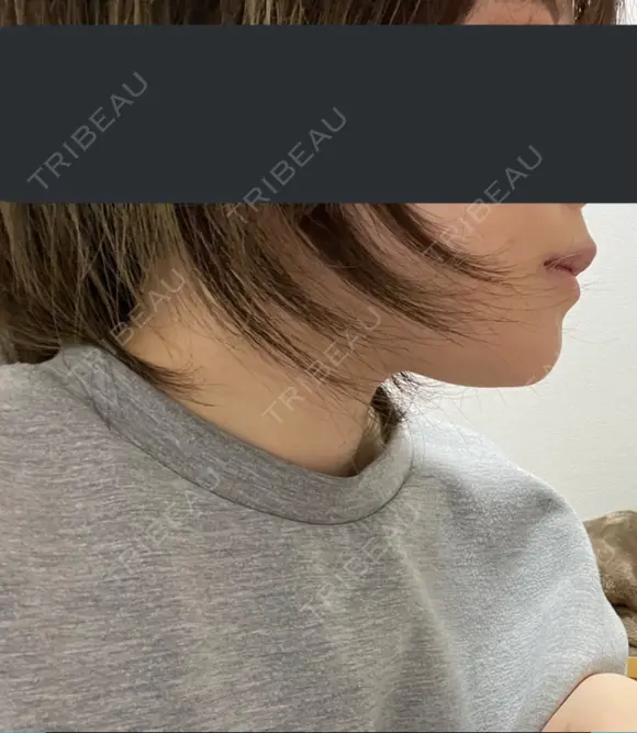 骨切り（あご） 銀座マイアミ美容外科 AFTER メイン用