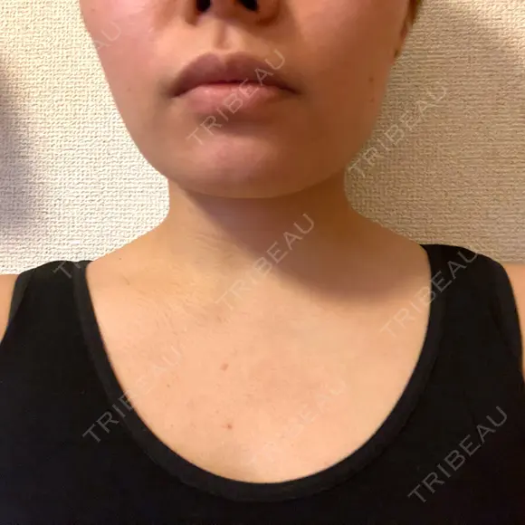 ボトックス（首） KOBE美容皮膚科 西宮院 DAY 13 メイン用