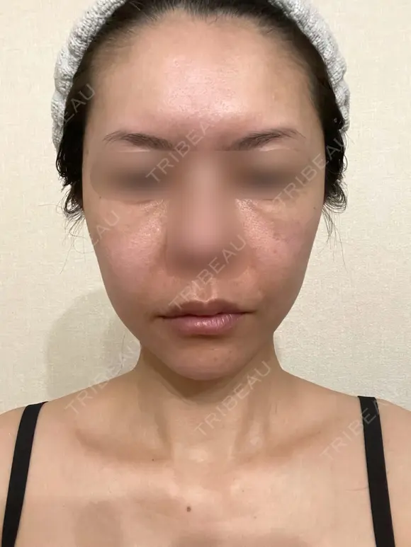 脂肪吸引（顔） / 切開リフト / 脂肪注入（輪郭） 牧野美容クリニック DAY 441 メイン用