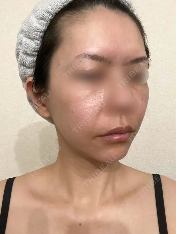 脂肪吸引（顔） / 切開リフト / 脂肪注入（輪郭） 牧野美容クリニック DAY 441 メイン用