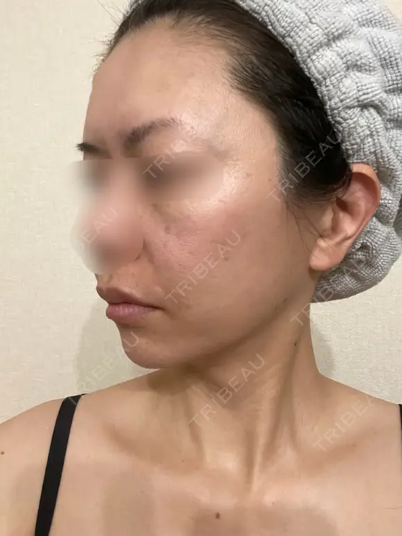 脂肪吸引（顔） / 切開リフト / 脂肪注入（輪郭） 牧野美容クリニック DAY 441 メイン用