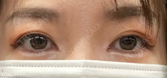 目頭切開 目白ポセンシアクリニック DAY 18 メイン用