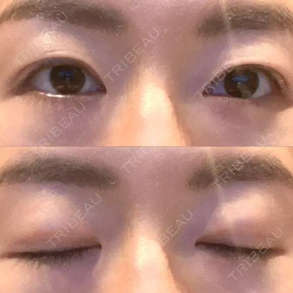 二重切開 城本クリニック 長崎院 DAY 179 メイン用