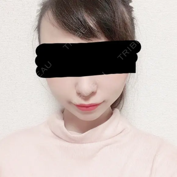 脂肪吸引（顔） / その他（輪郭） / 脂肪注入（輪郭） ヴィヴェンシアクリニック AFTER メイン用